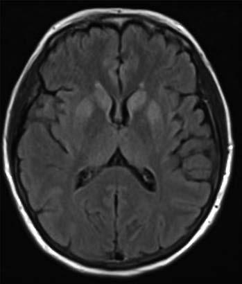 Obr. 1, 2. Ilustrativní MRI vyšetření mozku pacientů se scjn Obr. 1. FLAIR sekvence hyperintenzní změny bazálních ganglií, thalamu, kortexu Obr. 2. DWI sekvence hyperintenzní změny bazálních ganglií (především nucleus caudatus) oboustranně al.