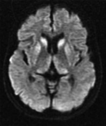 Patologickými změnami na MRI vyšetření mozku jsou hyperintenzity v bazálních gangliích (typicky v putamen a nucleus caudatus) na FLAIR a DWI sekvencích, dále pak hyperintenzity korově (hlavně