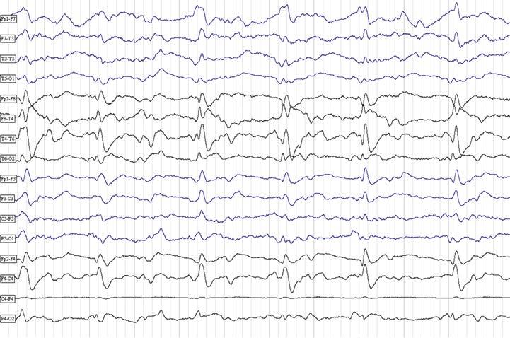 Obr. 3. EEG nález pacientky Obr. 4.