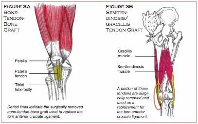 Obrázek 11: 3A - štěp z lig.patellae, 3B - štěp ze šlachy m.semitendinosus/m.gracilis (dubinchiro.