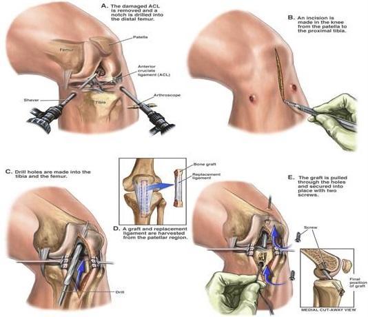 Obrázek 12: Plastika s BTB štěpem (calferguson.blogspot.cz.) Při užití štěpu ze šlachy m. semitendinosus se nedoporučuje současně odebrat šlachu m.gracilis.
