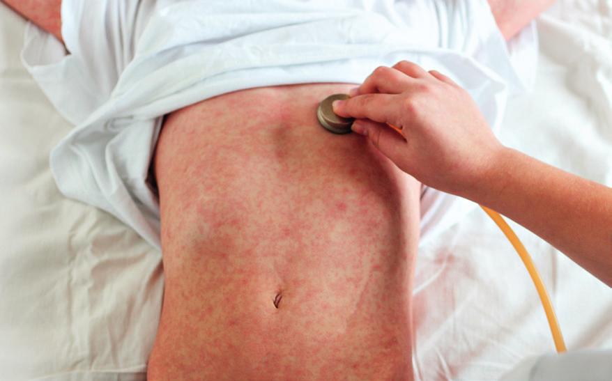 EPIDEMIE Jedna z nejnakažlivějších nemocí Foto: Shutterstock.com Spalničky (morbilli, measles) jsou exantémové infekční onemocnění.