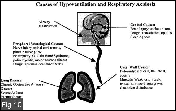vysokým obsahem bikarbonátů) Respirační alkalóza paco2 pod 4,5 kpa Příčiny: hyperventilace v důsledku úzkosti astma, lehčí plicní embolizace 1.