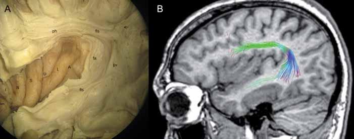 horizontalis b, pars verticalis; 3 sulcus periinsularis superior; 4 sulcus centralis insulae, gt gyrus transversus, ag gyrus accessorius, spcg subprecentrální gyrus. Obr. 1b.