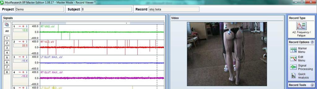 Příloha Ukázka surového EMG záznamů v programu Myoresearch XP Obr. 9.