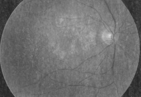 přečištěním a parciální hydrolýzou získáme poţadovaný benzoporfyrin derivát mono acid ring A 41.
