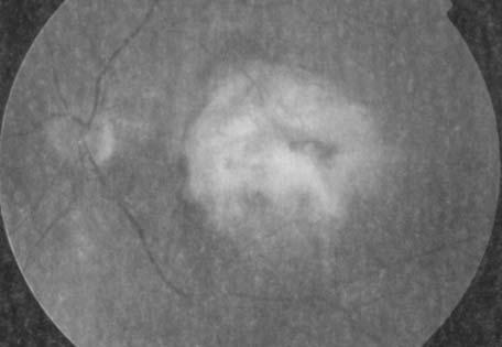Tato vlnová délka umoţňuje snadný průnik světla i přes melanin, krev a fibrotickou tkáň do subretinálních struktur 42.