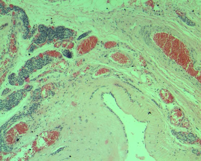 Histologický obraz cysty příštítného tělíska Obr.