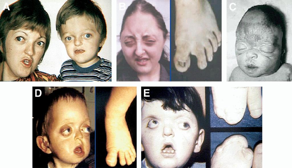 Diagnostika tohoto syndromu může být provedena prenatálně. Ve studii Gonzales et al. (2005) je popisována prenatální diagnóza tří plodů s Pfeifferovým syndromem a mutací ve FGFR2 genu.