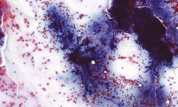 V pravém horním rohu je pak patrné dobře utvářené vazivové pouzdro s naléhajícími lalůčky příušní žlázy. Barveno hematoxylinem eosinem (zvětšení 140x). B Obr. 2. Warthinův tumor příušní žlázy (WT).