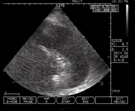 Perisplenic Pelvic (pouch of Douglas) Pleural + paracolic bilateral Q: is a