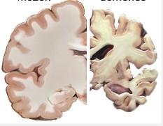 Demence choroby, u nichž dochází k významnému snížení paměti, intelektu a jiných