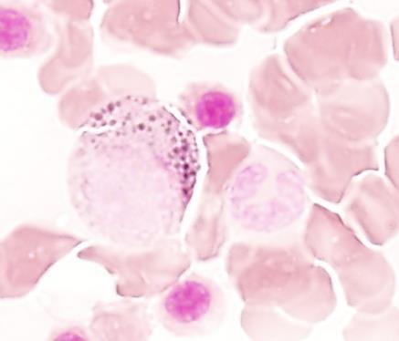 počet abnormálních sideroblastů zásoby železa myeloperoxidáza přítomnost či nepřítomnost Auerových tyčí
