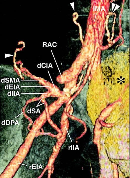 Dvoudobá transplantace slinivky a ledviny (slinivka odhojena a transplantována nová) d = dárcovská, r = pravá, l = levá CIA = a. iliaca com., CIVB = bifurcation v. iliacae com., DPA = a.