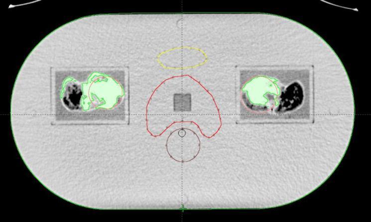 Obrázek 5: Transverzální CT řez fantomem malé pánve.