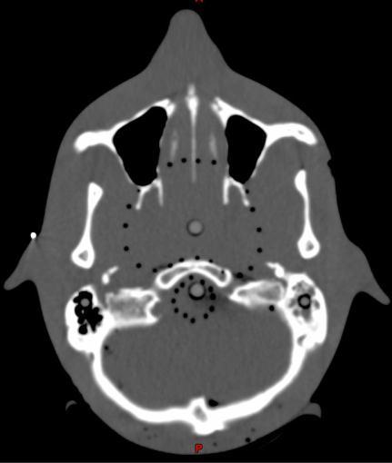 Obrázek 8: CT řez fantomu hlavy. Pomocí malých vzduchových otvorů je ve fantomu vyznačen nazofaryng (cílový objem) a mozkový kmen (kritický orgán). Šipky ukazují umístění ionizačních komor.