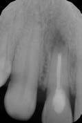 MALÉ ILUSTROVANÉ REPETITORIUM 277 Obr. 1: Klinická fotografie zubu 12 před započnutím terapie. Je viditelná jizva po submarginálním řezu. TEST 25 ŘEŠENÍ Obr.