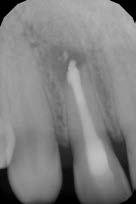 Ad 4: Hojení mohou ovlivnit dva faktory: a) Ostrý resekční úhel. V rámci retrográdního endodontického ošetření se snažíme o dosažení co nejkolmějšího úhlu vzhledem k dlouhé ose zubu.