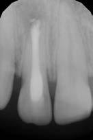 ostrém resekčním úhlu totiž dochází k otevření většího množství dentinových tubulů, které dávají vznik komunikaci mezi kořenovým kanálkem a periradikulárními tkáněmi.