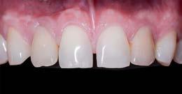 Závěr: Ortográdní reendodontické ošetření zubů, u nichž došlo k selhání retrográdního endodontického ošetření, může být vhodnou metodou zvláště v případech, kdy retrográdní endodontické ošetření