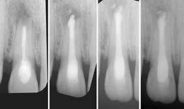20: Klinická fotografie zubu 12 zhotovená 12 měsíců po provedení ošetření. Obr. 21: Klinická fotografie horního frontálního úseku zhotovená 12 měsíců po provedení ošetření.
