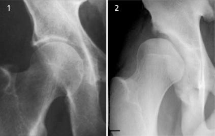 mechanická příčina osteoartrózy mm
