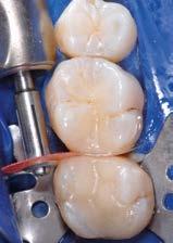 : Demi plus (Demetron) PenCure (Morita) Bluephase (Ivoclar Vivadent) G-Light (GC) SPEC 3
