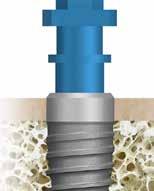 Preparace lože implantátu Používání zahlubovací frézy implantát BioniQ Plus Implantát BioniQ Plus umožňuje využít různé hloubky zanoření implantátu dle indikace a tloušťky gingivy.