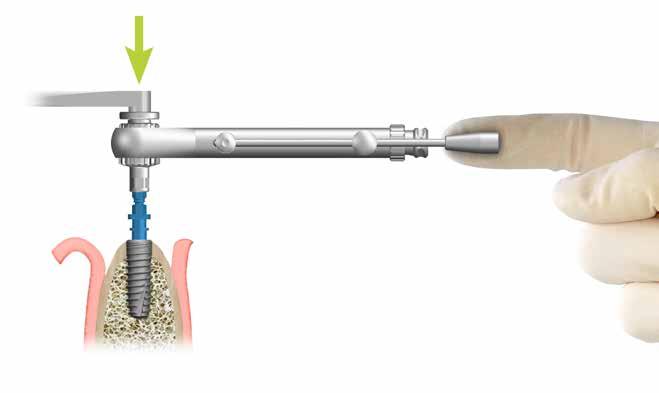 Zavádění implantátu Při zavádění implantátu dbejte na správné vedení nástroje v ose preparovaného kostního lože.