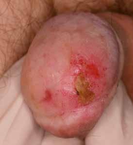 A B Obr. 4. Muž, 62 let, 3 roky po cirkumcizi, histologicky balanitis xerotica obliterans (novou nomenklaturou lichen sclerosus).