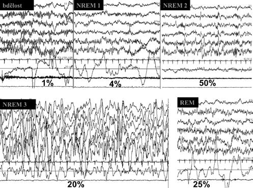 Fyziologie spánku a význam spánku Obr. 1.1 Spánková stadia: polysomnografický obraz a procentuální zastoupení během noci Hodnocené parametry směrem shora: 6 svodů EEG, EKG, EOG a EMG svalů brady.