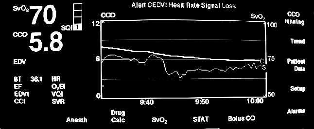 Monitorace SvjO2 CMRO2 = DajO2 x CBF SvjO2 CBF/ CMRO2