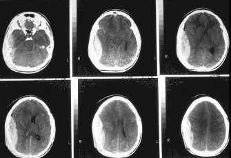 Klinické použití monitorace následků ischemického poškození mozkové tkáně (sekundárního