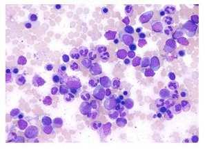 1. Mnohopočetný myelóm Mnohopočetný myelóm alebo aj symptomatický mnohopočetný myelóm ( Multiple Myeloma ) (MM) sa zaraďuje medzi ochorenia, ktoré sa označujú ako monoklonálne gamapatie.