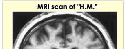 Declarative memory - patient H.M.