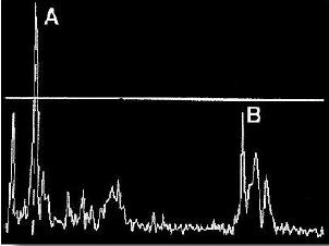 Obr.2 A-scan [8] B mód zobrazení - Zaměněním výchylkové modulace v A-scanu za modulaci jasovou, tedy jas stopy modulován velikostí signálu akustických ech ve směru hlavního uzv paprsku svazku.