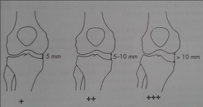 mm), dva křížky pro střední nestabilitu (5-10 mm) a tři křížky velkou nestabilitu (nad 10 mm).