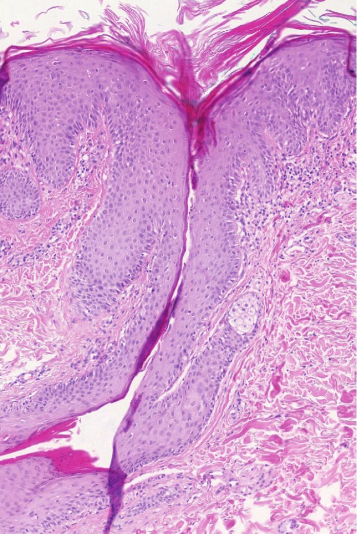 3). s keratolytiky a kortikosteroidy, které přineslo p. o., i přes zatím biopticky neověřenou diagnó jen minimální efekt a malou subjektivní úlevu zu.