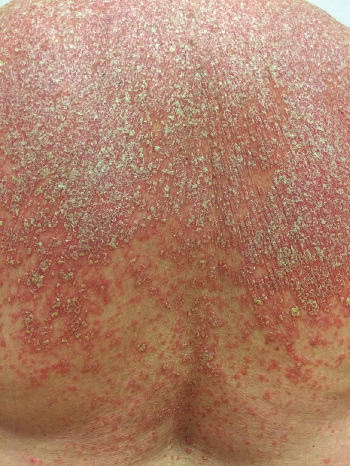 Vzhledem ke klinickému na počátku byl podáván v dávce 25 mg/den, nálezu bylo podezření na pityriasis rubra pilaris. postupně dávka navýšena na 50 mg/den.