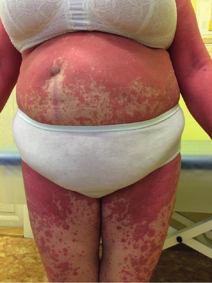 mmol/l) byla nasazena trvávala výraznější lamelózní deskvamace (možný stupně došlo k dorůstání vlasů (foto 7, 8. 9). diabetická dieta.