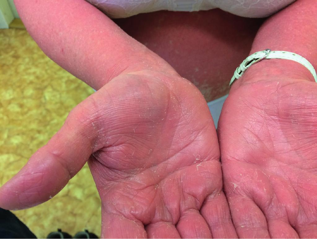 Diskuze byla z ambulantně provedené excize potvrzena Pacientka po dimisi pokračovala v užívání diagnóza pityriasis rubra pilaris.