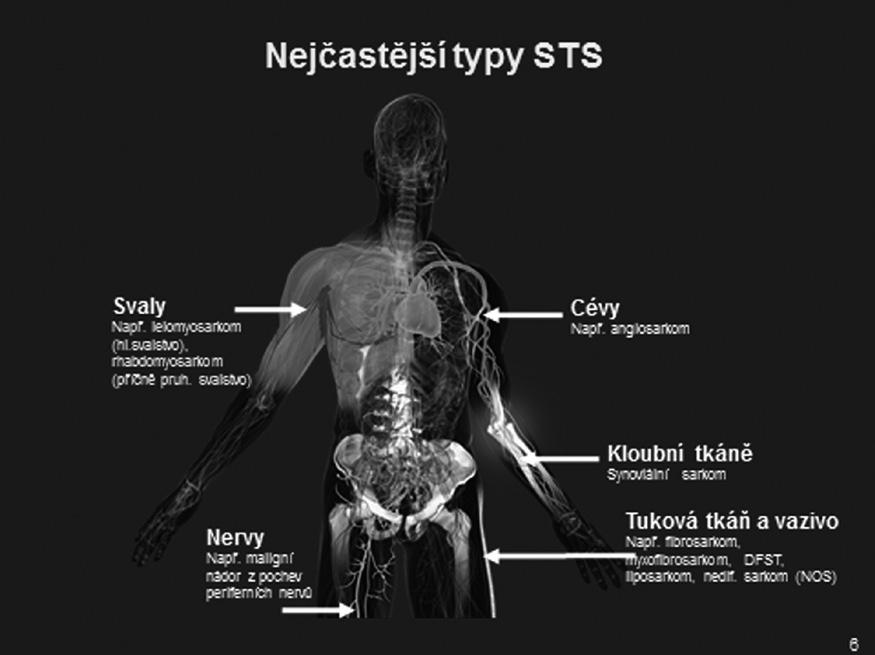 tenců, méně často v oblasti retroperitonea (prostor mezi zadní stěnou břišní a nástěnnou pobřišnicí) či jinde.