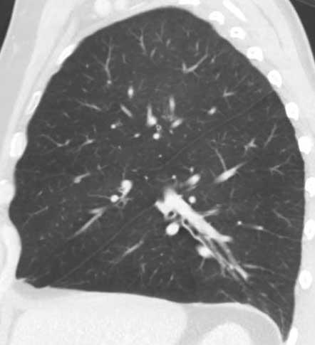 Kolaterální ventilace CV Komunikace: interalveolární, bronchioloalveolární, interbronchiolární, intersegmentární, interlobární u plicního emfyzému v 66% adaptace na CHOPN X efektu BLVR-EBV CV negat.