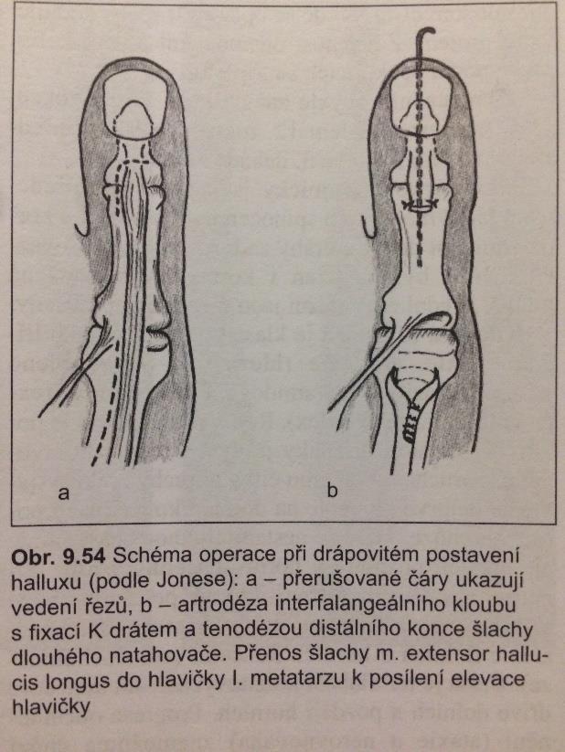 hlavičku prvního metatarzu. K nápravě equinózního (přepadávající špička) postavení nohy se provádí prolongace Achillovy šlachy a flexorů prstů.