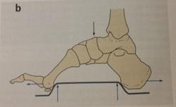 Nejvhodnější ortotickou léčbou této vady je využití ortopedických vložek a vhodné obuvi, dále také možnost využití FO foot orthosis (nožní ortézy).