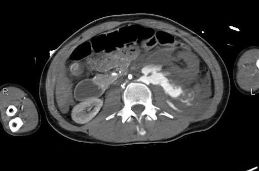 Kolabovaná aorta Avulze ledviny Bez opacifikace Hemoperitoneum