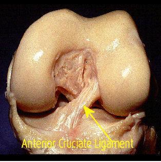 Obrázek 1. Ligamentum cruciatum anterius (http://www.acl-plastika.wbs.cz/).