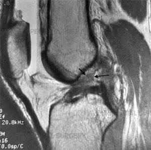 Obrázek 12. Snímek MR přetrţení LCA (http://www.hss.edu/conditions_acl-reconstruction-newadvances.asp). 1.5.