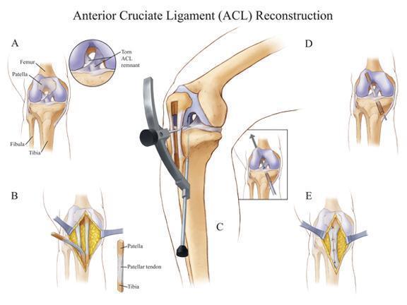 b) Odebrání ligamentózního autoštěpu ze šlach m. semitendinosus nebo m. gracilis (ST/G) c) Vyuţití tkáně od dárce (allogenní štěp) d) Vyuţití umělého materiálu (Dungl, a další, 2005).