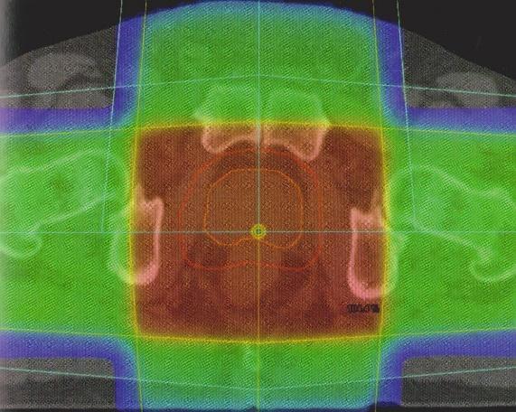 tvaru plánovacího cílového objemu (Hynková, 2012, s. 39). 8 (DOLEŽEL, Martin. Cílená radioterapie karcinomu prostaty.